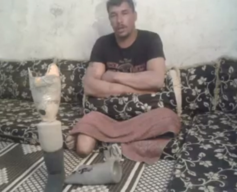 نداء مناشدة للتكفل بتأمين قميص طرف صناعي للاجئ فلسطيني من أبناء مخيم درعا 