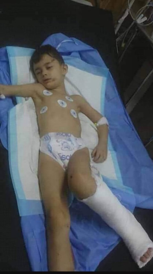 إصابة طفل من أبناء مخيم النيرب بعد تعرضه لحادث صدم من قبل دراجة نارية 