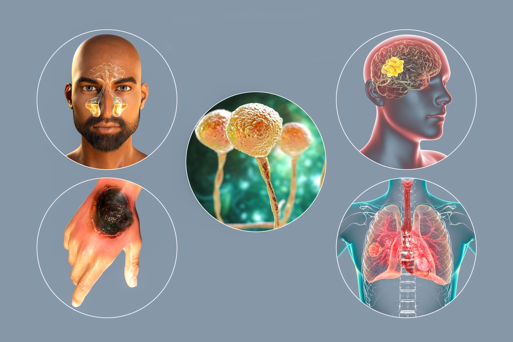 المخيمات الفلسطينية.. تحذيرات من مرض الفطر الأسود