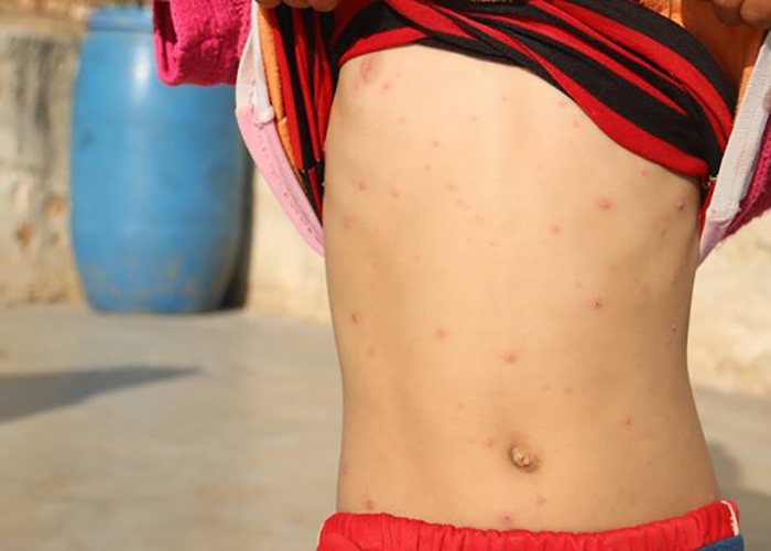 مرض جدري الماء ينتشر بين أطفال مخيم النيرب 