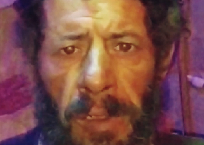 شاهد: فلسطيني في الشمال السوري إصابتي حولت حياتي لجحيم وفاقمت مأساتي 