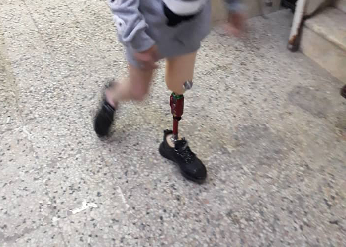 مخيم النيرب. طفلة فلسطينية تناشد للتكفل بتركيب طرف صناعي لقدمها المبتورة