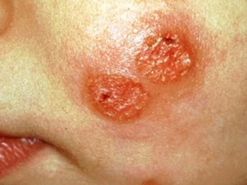 بعد تسجيل 14 إصابة.. مخاوف من تفشي مرض الليشمانيا في قرية حيفا الكرمل