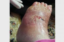 الشابة الفلسطينية السورية "آية تيسير شحادة" مهددة بالشلل نتيجة خطأ طبي فادح   