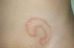 عدوى جلدية تصيب النازحين في مخيمي دير بلوط والمحمدية 