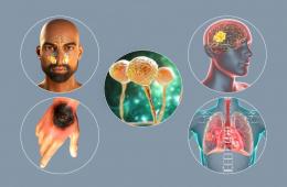 المخيمات الفلسطينية.. تحذيرات من مرض الفطر الأسود