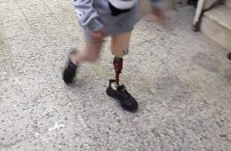 مخيم النيرب. طفلة فلسطينية تناشد للتكفل بتركيب طرف صناعي لقدمها المبتورة