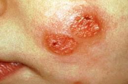 بعد تسجيل 14 إصابة.. مخاوف من تفشي مرض الليشمانيا في قرية حيفا الكرمل